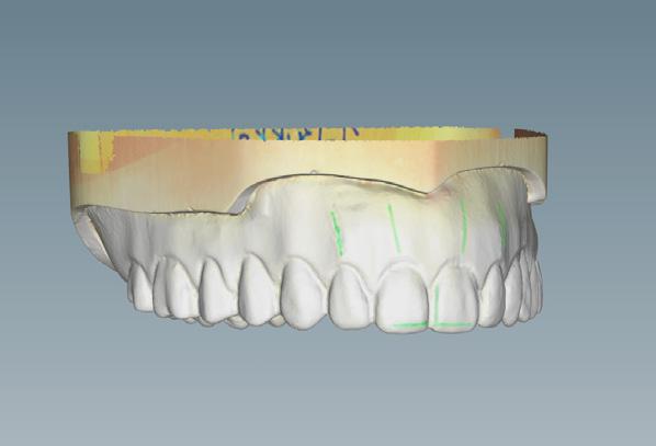 Generación en CAD La función para crear prótesis monoblock se puede seleccionar en el menú contextual después de modificar las bases y los dientes de la prótesis.