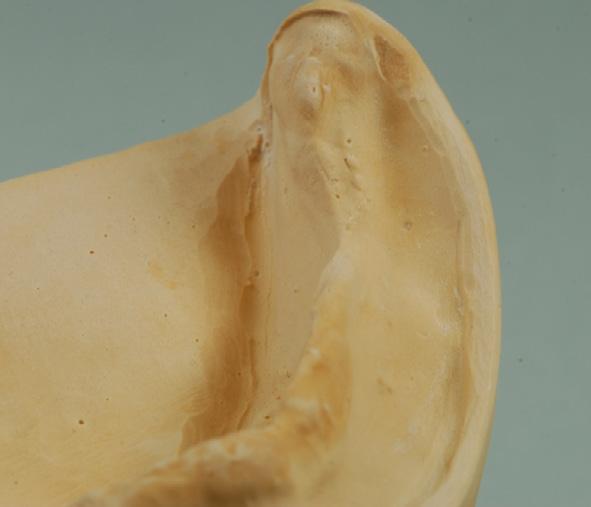 Las socavaduras en la zona del pliegue mucobucal se deben a unos márgenes del modelo demasiado altos.