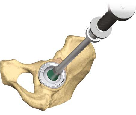 Inserción del inserto acetabular Una vez lograda la orientación satisfactoria del cotilo, el cirujano debe comenzar la preparación para cementar el inserto cementado en el cotilo REDAPT.