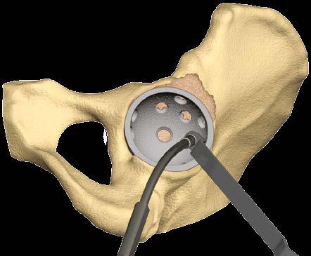 Inserción del tornillo acetabular Sugerencias quirúrgicas: Los tornillos pueden utilizarse para aumentar la fijación y asegurar el cotilo.
