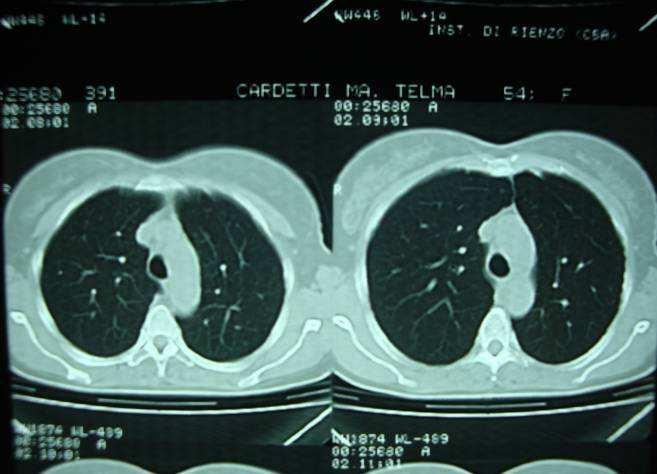 TAC 2007 Fibrosis Cicatrizal