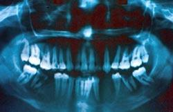 Previo a la cirugía se debe tratar periodontalmente al paciente, para así eliminar posibles factores irritantes locales asociados a lesión y a los dientes involucrados en esta, de lo contrario la
