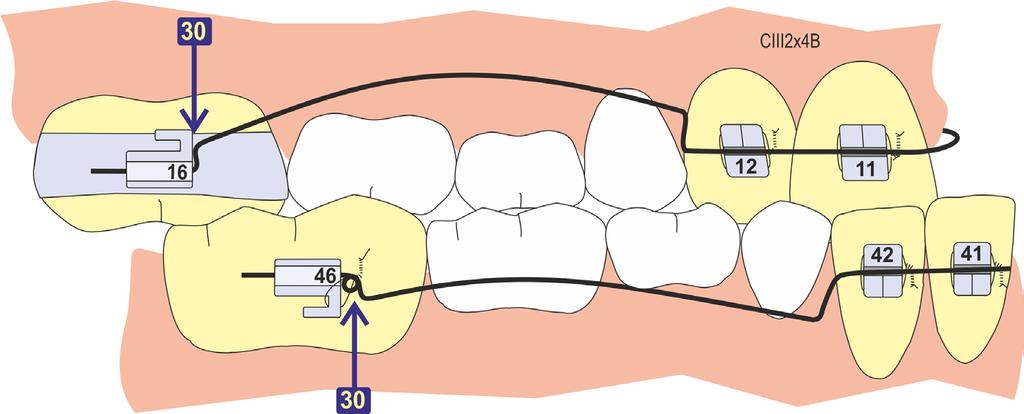 Arco 2x4, después de ligar - Vista Vestibular Corrección de articulación funcional de Clase IIIª en