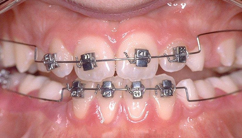 IIIª en Dentición Mixta 8 Protocolo