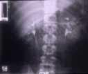 Se coloca al paciente en la mesa y se toman imágenes estáticas de rayos X.