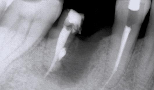 6, hemisección, extracción de la raíz mesial y posterior restauración mediante prótesis fija, incluyendo el 4.5 como pilar aprovechando la presencia de una restauración en dicho diente.