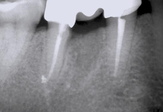 La literatura describe que la hemisección y extracción de la raíz distal en molares inferiores tiene buen pronóstico debido a su menor tamaño y porque resulta ser menos retentiva que la raíz mesial,