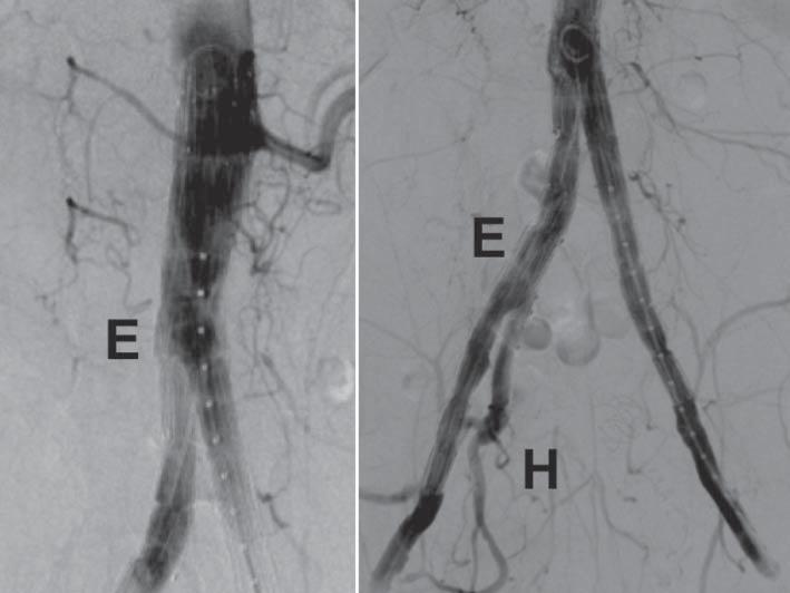 Angiografía posterior al despliegue del stent cubierto (flecha) que une la endoprótesis (E) con la arteria hipogástrica (H).