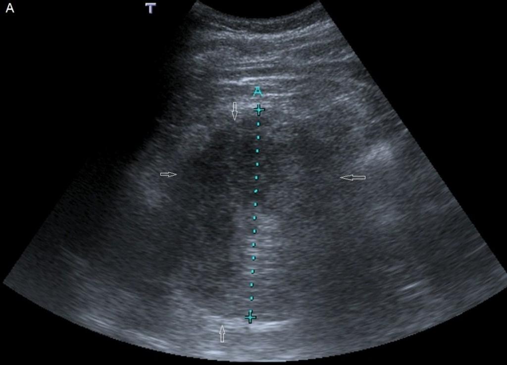 Fig. 7: Figura 3A. Carcinoma suprarrenal izquierdo con sangrado retroperitoneal. A: Ecografía. Masa sólida en el sitio teórico de la glándula adrenal izquierda (flechas huecas).