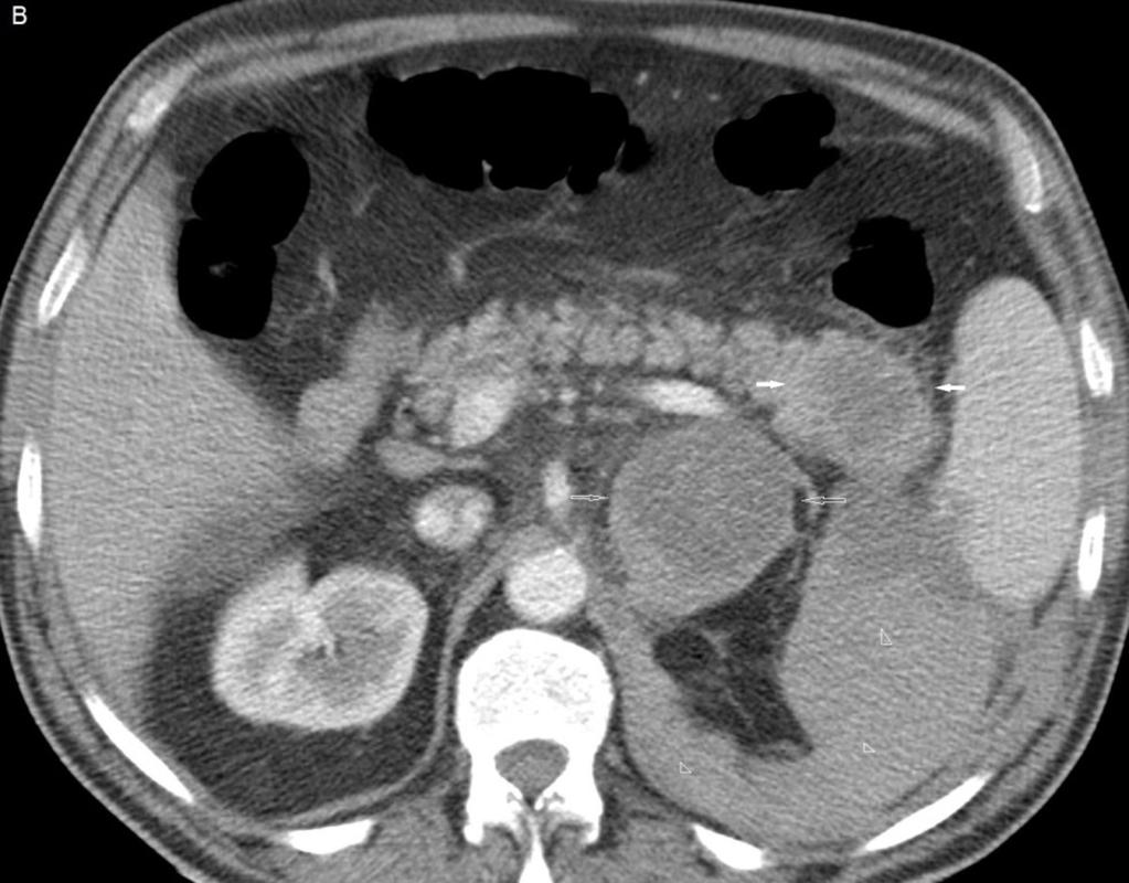 B: En la imagen de TC con contraste intravenoso (civ) se confirma una tumoración sólida en cola del páncreas (flechas blancas), tumoración adrenal izquierda (flecha hueca) y sangrado en el espacio