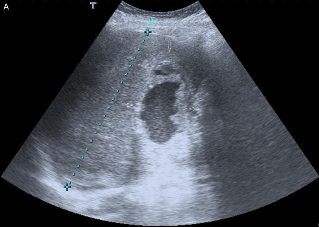 Fig. 3: Figura 2A. Adenocarcinoma de cola de páncreas con invasión de arteria esplénica, infartos esplénicos y hematoma periesplénico en mujer post-parto. A: Ecografía.