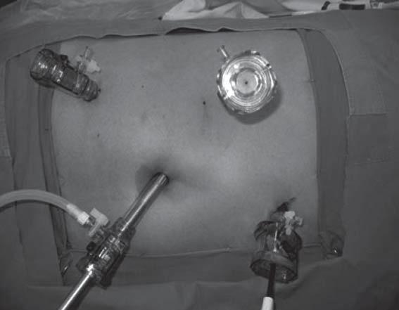 OCTAVIO A. CASTILLO C. y cols. reparadas por vía laparoscópica, requiriendo conversión a cirugía 3 casos. No hubo mortalidad en la serie.