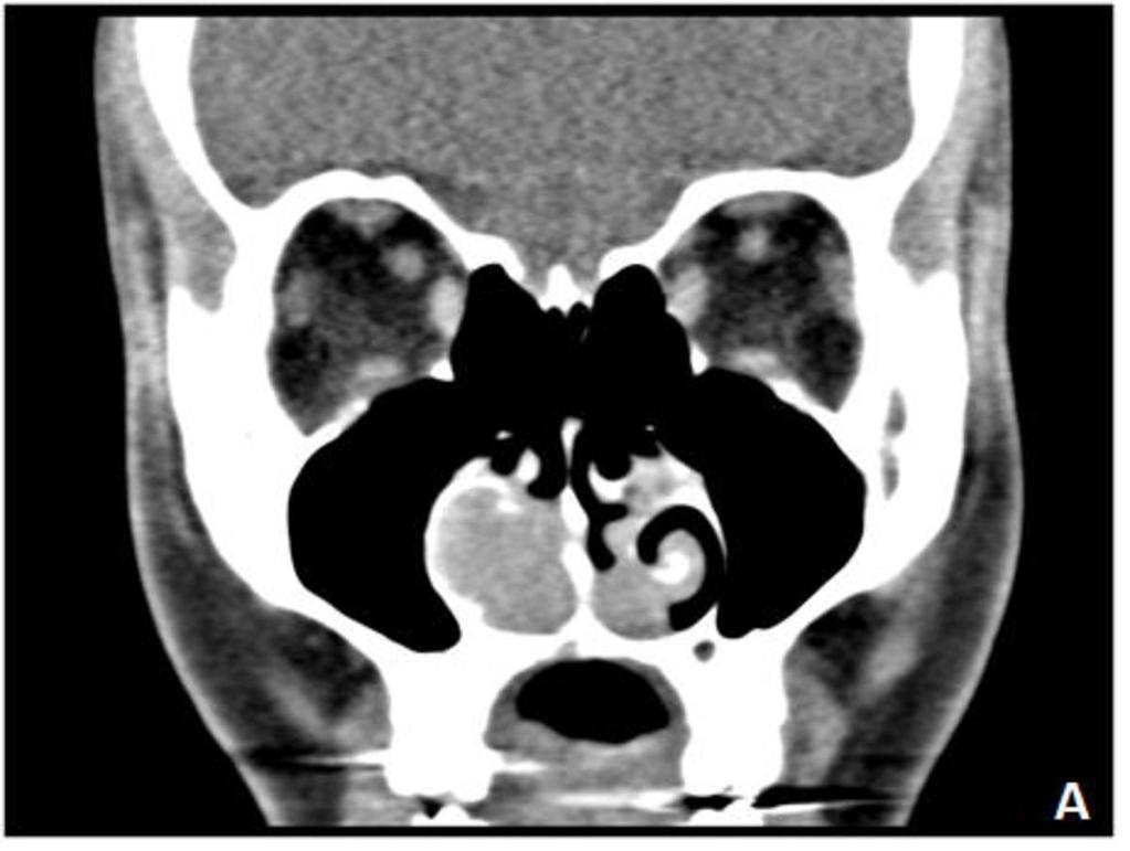 Fig. 24: Plasmocitoma: Hallazgos en TC. (A) Reconstrucción coronal. Lesión redondeada en cornete medio y polipósis nasal bilateral.