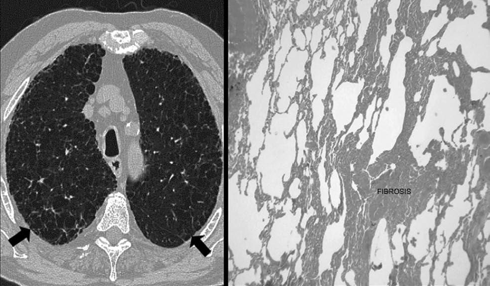 Fig. 5. Fibrosis pulmonar idiopática. Correlación radio-patológica.