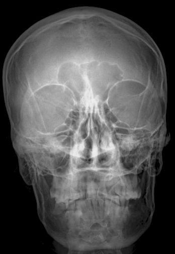 Articulación atloaxoidea 10. Porción escamosa del occipital 11. Depresiones de Pacchioni 12. Seno Frontal 13. Yugo esfenoidal 14.