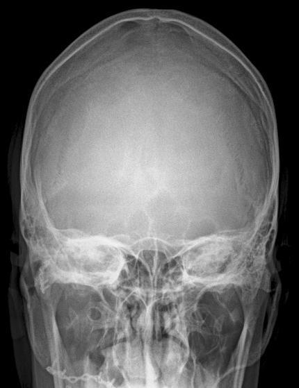 UNIVERSIDAD NACIONAL DE LOJA RADIOLOGIA E IMAGEN DIAGNOSTICA Estructuras mostradas La proyección AP muestra una imagen simétrica de los peñascos, la porción posterior del agujero occipital, la lámina
