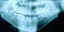 No se ha realizado ningún tipo de mentoplastía como puede observarse en las radiografías post cirugía.