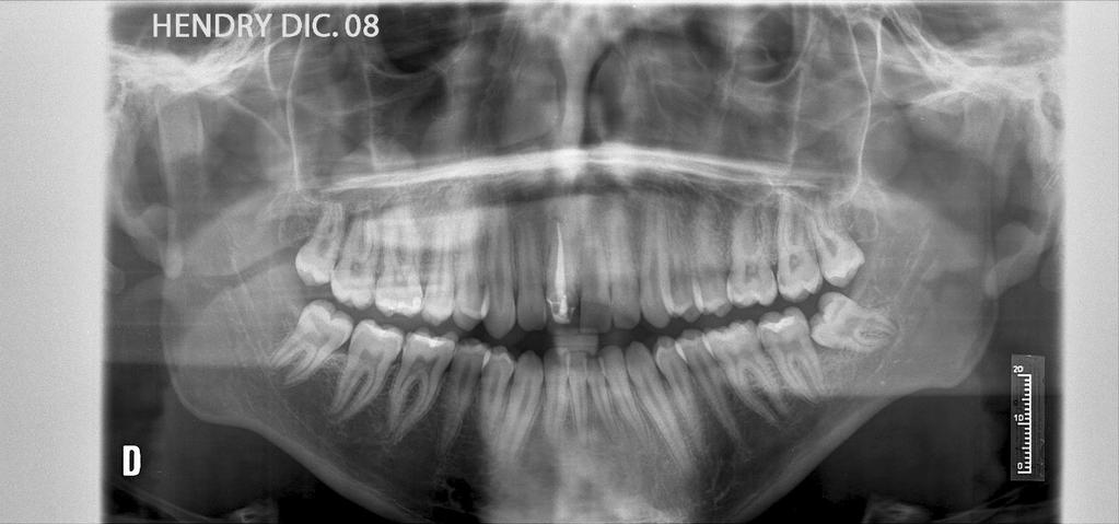 Historia previa de tratamientos ocluso-dentales: - A los 9 años inicia tratamiento de ortodoncia removible (placa superior de expansión removible).
