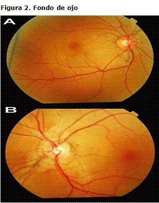 Examen oftalmológico: agudeza visual 20/25 en el OD y 20/40 en el OI, en el fondo de ojo se observan estrías angioides bilaterales con márgenes irregulares, irradiando en forma de huso desde el disco
