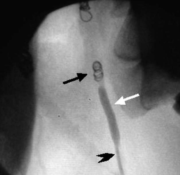 Figura 8: Imagen fluoroscópica de bobinas de embolización (flecha negra) oclusión de la arteria carótida interna en un caballo afectado con micosis de la bolsa gutural.