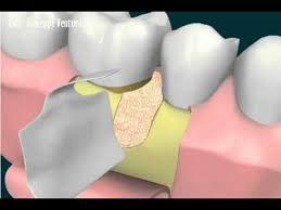 periodontales y