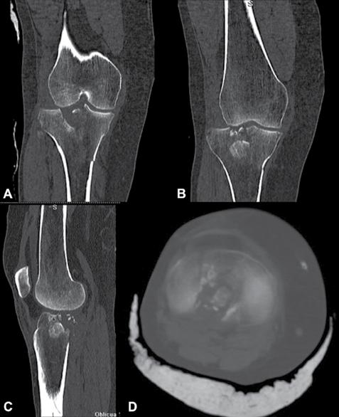 ARTROSCOPIA VOL. 25, N 1: 21-28 2018 Figura 6: Cortes tomográficos paciente anterior.