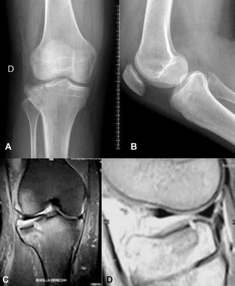 ARTROSCOPIA VOL. 25, N 1: 29-34 2018 REPORTE DE CASO Figura 1: Radiografía de rodilla derecha, frente (A) y perfil (B), donde se muestra la fractura del platillo tibial externo.