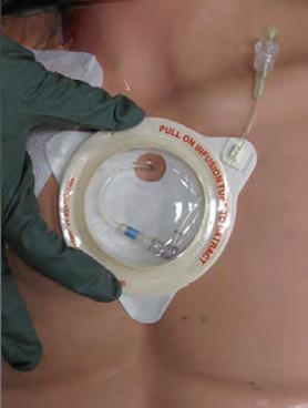 Precaución: Evite fuerza extrema, movimientos de torsión o de golpe. 4. Conecte el tubo de infusión: Conecte el tubo de infusión al conector hembra en ángulo agudo.