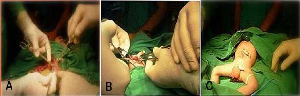 Figura 3. Proceder quirúrgico. A: Ampliación del anillo herniario. B: Introducción de las vísceras en la cavidad sin provocar un aumento excesivo de la presión intraabdominal. C: Cierre de la cavidad.