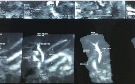 Imagen transquirúrgica en la que se observa La paciente evolucionó satisfactoriamente en el postquirúrgico inmediato.