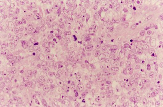 LINFOMA CENTROBLÁSTICO POLIMÓRFICO FOTOGRAFÍA N 3: Se observan células tumorales de