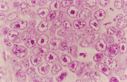 Algunas de las células tumorales tienen características plasmocitoides.
