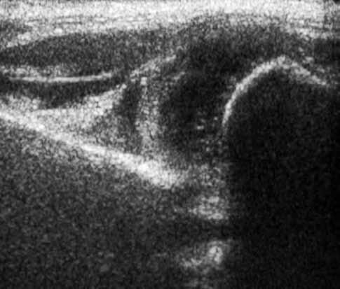 d) Cadera Tipo IV: describe también una cadera descentrada, pero con desplazamiento inferior, hacia el cotilo, del techo cartilaginoso, el que se interpone al