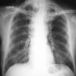 Nocardiosis pulmonar Ingreso por vía inhalatoria.