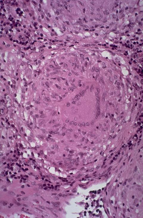 Histopatología Granulomas con necrosis caseosa