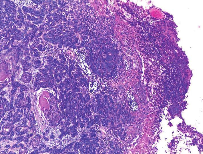 Yohana Moyano y colaboradores 3 Fig. 5: Anatomía patológica de carcinoma basocelular ulcerado (Hematoxilina/Eosina 100x).
