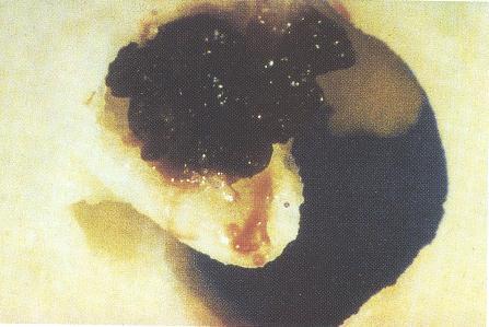 Aterosclerosis (IV) Ruptura de placa y trombosis: Plaque rupture Vessel wall Thinning of fibrous cap Hemorrhage from