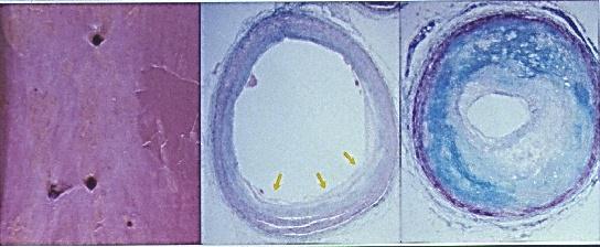 Aterosclerosis (II) Formacion de la estria grasa: Adherence + entry of leukocytes/ monocytes VSMC migratio n Vessel wall Foam-cell formation T-cell