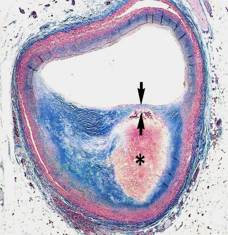 Aterosclerosis (III) Formación de la Placa : Macrophage accumulation Vessel wall Formation of necrotic core