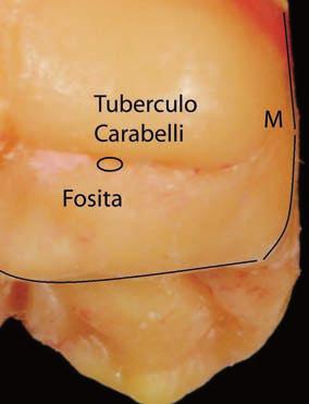 En el lóbulo mesial está el tubérculo de Carabelli. 1.4 Cara palatina Se estrecha hacia cervical (Figura 17). La cúspide MP es la más alta.