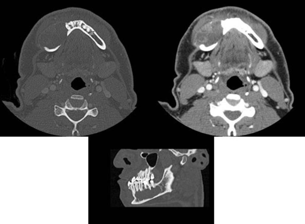 Fig. 7: Ortopantomografía de varón de 41 años donde se identifica gran lesión lítica en rama horizontal derecha de mandíbula con rizólisis de las piezas dentarias adyacentes correspondiente a