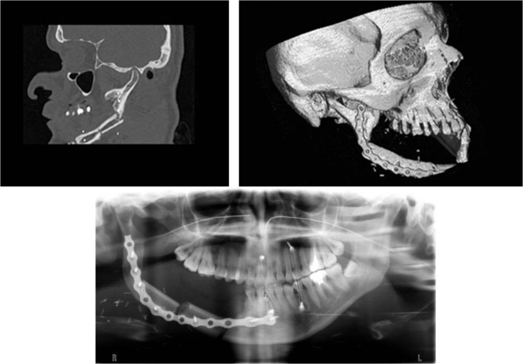 Fig. 9: Reconstrucción oblicua siguiendo la mandíbula y reconstrucción 3D de TC facial y ortopantomografía del