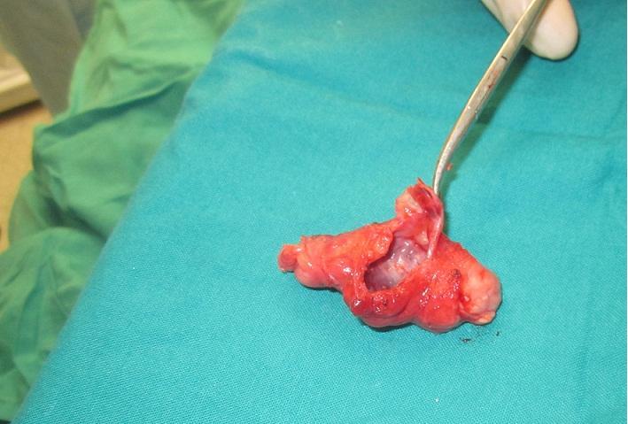 Fig. 3: Quiste y tejido tímico luego de la extracción. DISCUSIÓN La presencia de tejido ectópico tímico cervical constituye un espectro de enfermedades congénitas por defecto en la migración del timo.