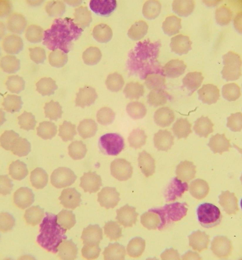 La LLC clásica está formada por linfocitos pequeños con núcleo de cromatina madura.
