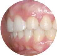 11/1/19-12 /1/19 > Tratamiento de dientes ectópicos: - Caninos incluidos - Centrales incluidos - Molares