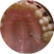 TRATAMIENTOS INTERDISCIPLINARES 17/5/19-18/5/19 > Particularidades del tratamiento de ortodoncia en el paciente adulto > Ortodoncia y periodoncia. Lo que todo ortodoncista debe conocer.