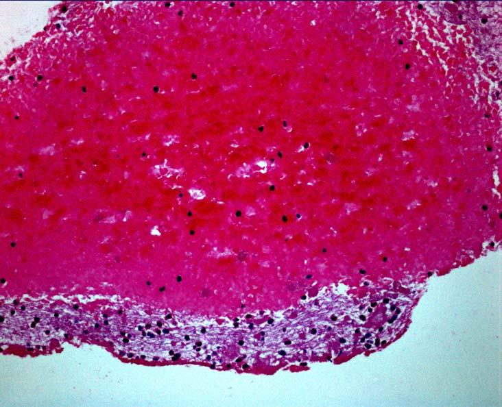presencia de fibrina, eritrocitos y granulocitos con núcleos intactos.