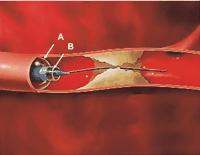 Figura 7. Proxis. A balón de protección proximal. B sistema a través del cual pasa la guía de angioplastia y los dispositivos necesarios para la ICP. Tomado de Gorog et al. JACC 20