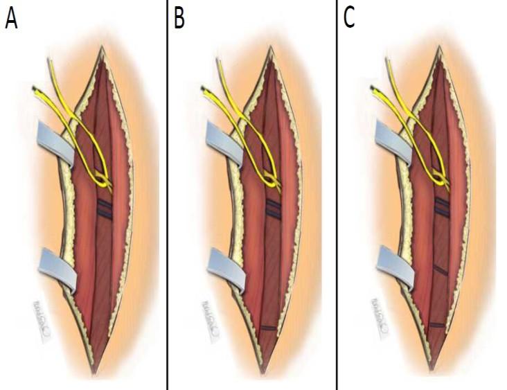 Su irrigación depende de ramos de la arteria femoral profunda o de la arteria circunfleja femoral medial mientras que su drenaje venoso depende de la vena femoral profunda, estos ramos conforman uno