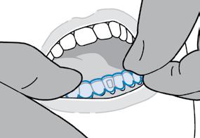 Para evitar que los attachments pierdan su forma o se despeguen, Align recomienda los siguientes materiales de composite dental: - Ivoclar Tetric EvoCeram (con adhesivo GC G-Bond) - M Filtek Supreme